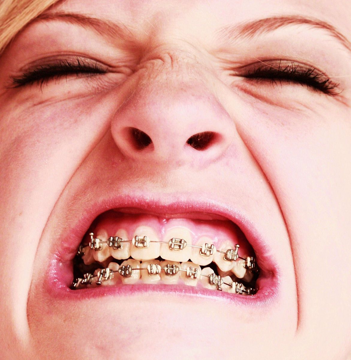 Braces near me girl in pain