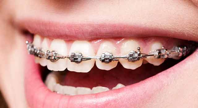 conventional braces
