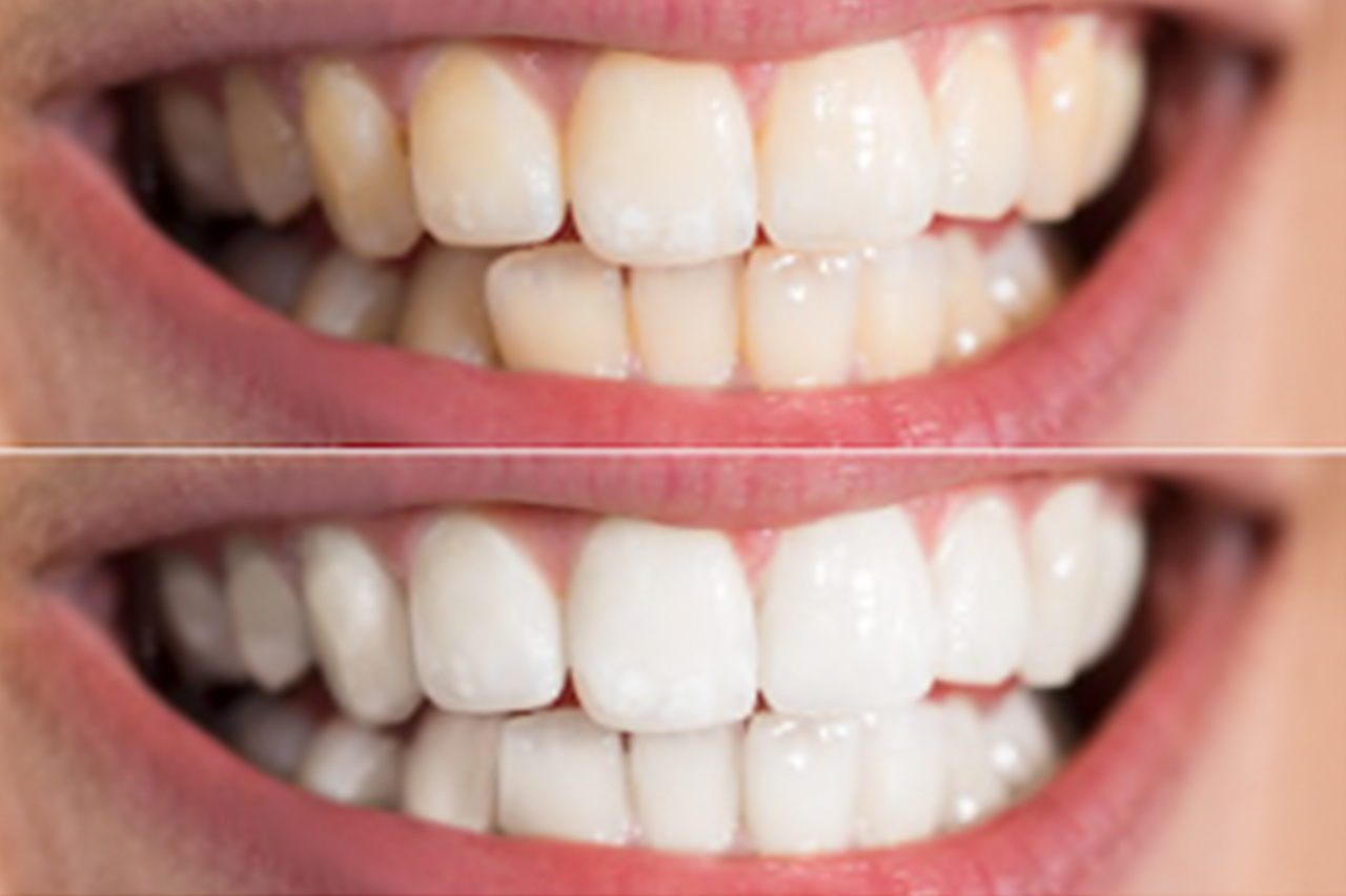 teeth whitening summary