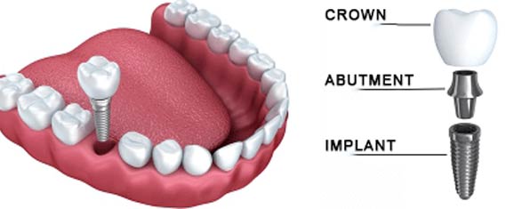 Implants: Crown / Abutment / Implant image