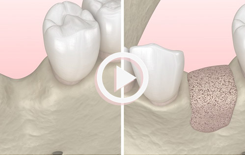 dental implant bone grafting image