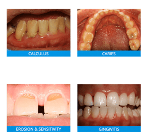 dental emergency flouride images of treatable diseases