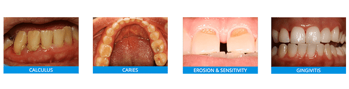 general-dentistry-fluoride