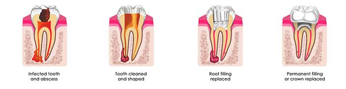 general dentistry root canal treatment horizontal