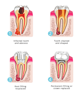 general dentistry root canal treament