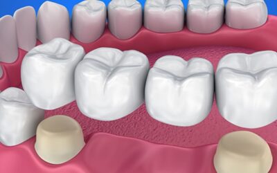 Dental Crowns and Bridges