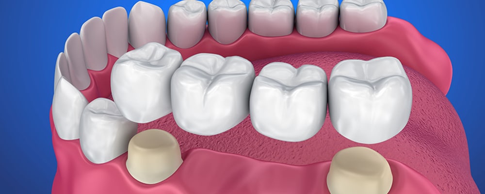 Dental Crowns and Bridges