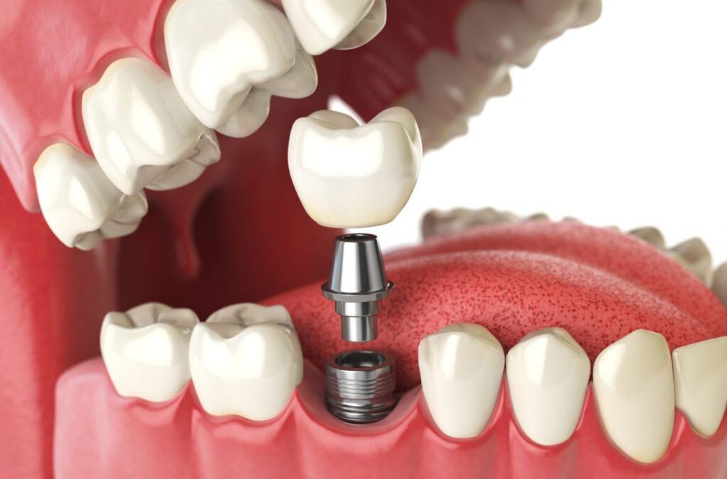 affordable dental implants cost