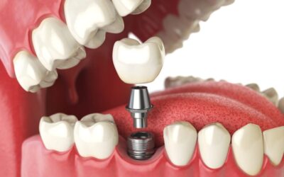 affordable dental implants cost