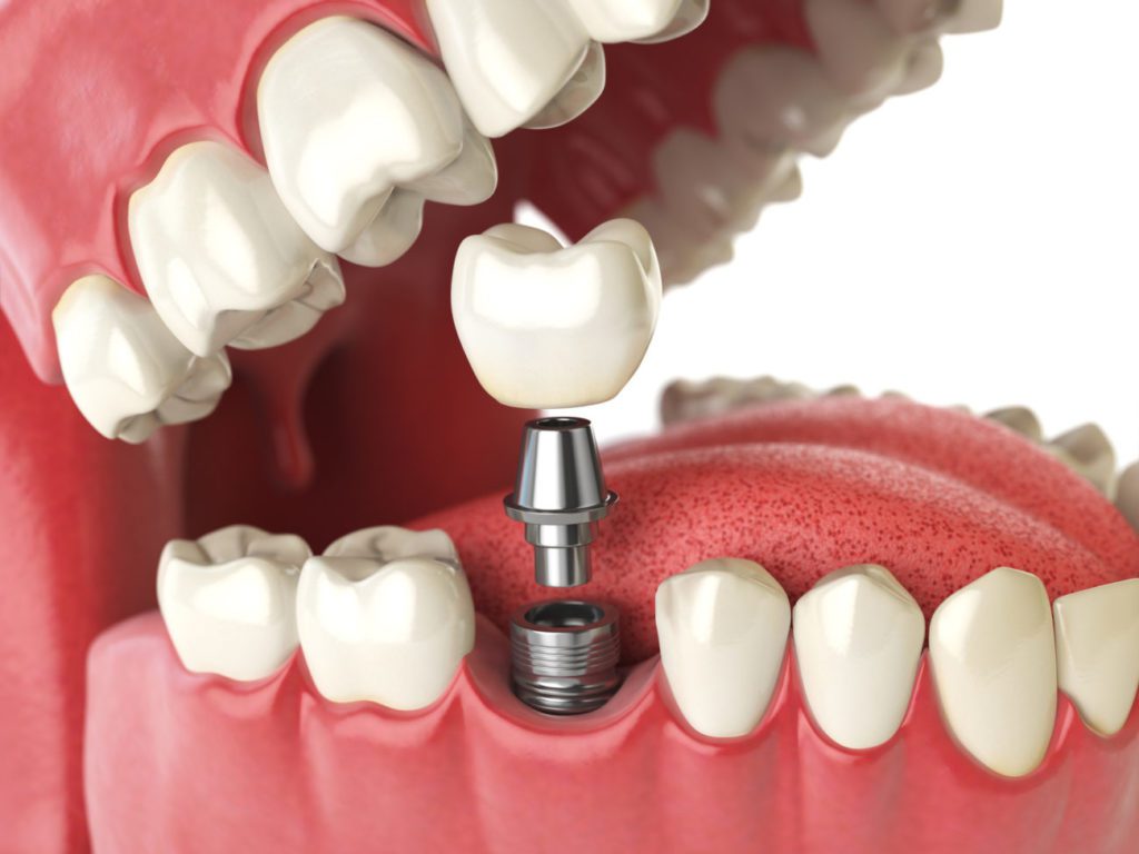 affordable dental implants cost