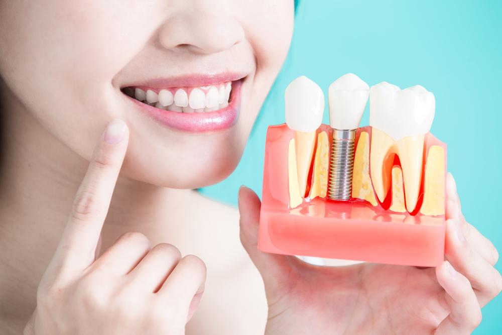 cheapest dental implants