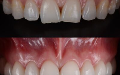 Dazzling Transformations: Dental Veneers Before & After