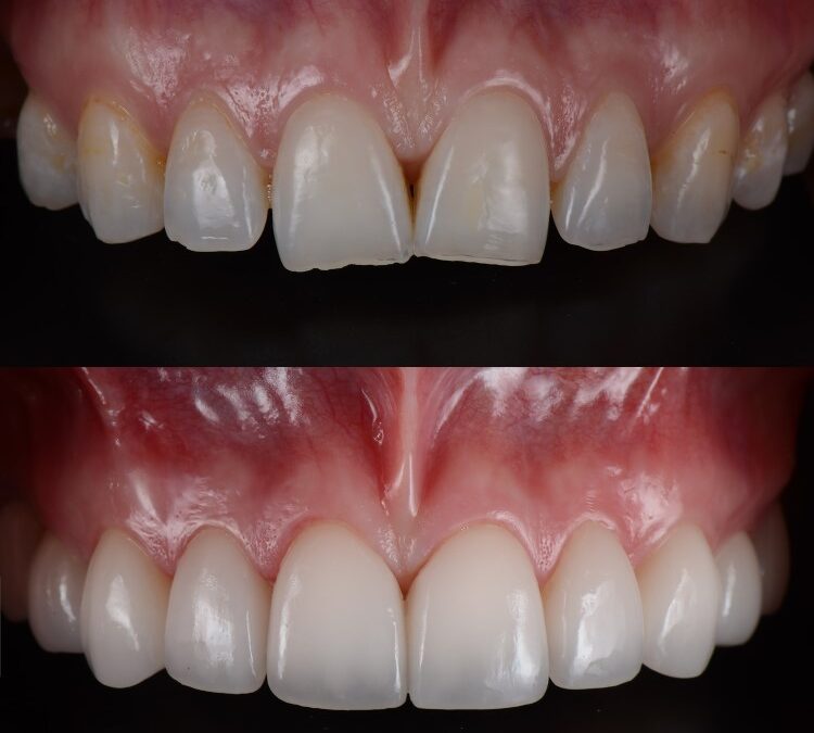 Dazzling Transformations: Dental Veneers Before & After