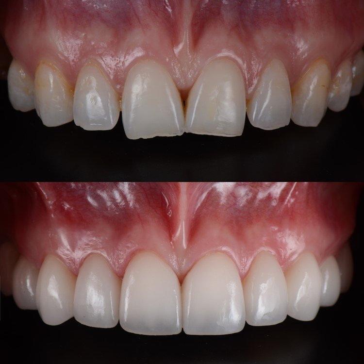 cost dental bonding vs veneers