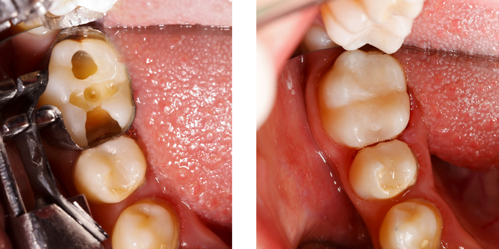 cracked tooth root canal