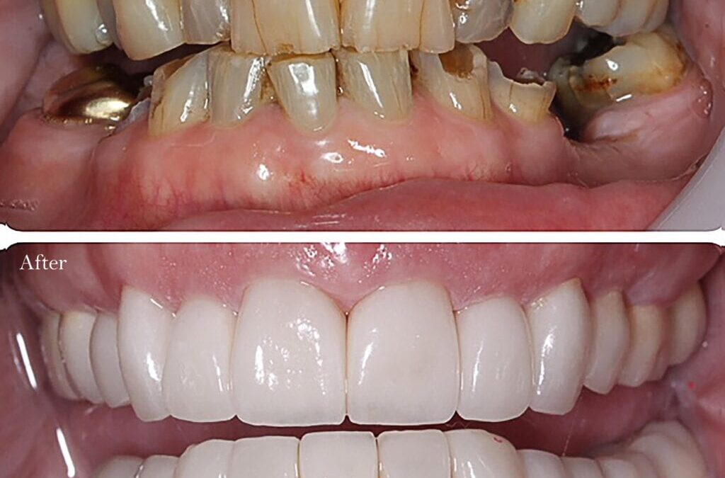 Revitalize Your Smile: Crowns for Teeth Excellence