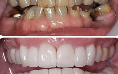 Revitalize Your Smile: Crowns for Teeth Excellence