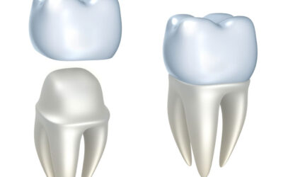 Dental Implant vs Bridge: Choosing Your Best Smile