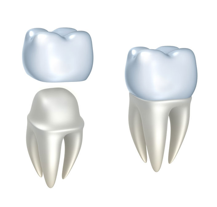 Dental Implant vs Bridge: Choosing Your Best Smile