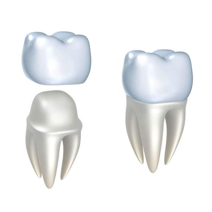 dental crowns near me