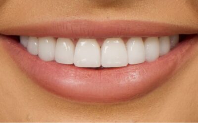 Find Dental Veneers Cost Near Me: Enhance Your Smile