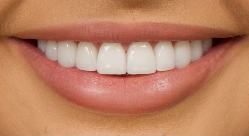 dental veneers cost near me