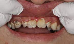 front tooth filling