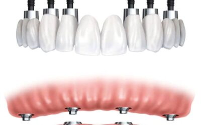 full mouth dental implants cost