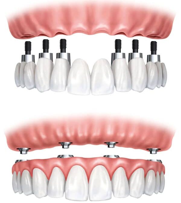 full mouth dental implants cost