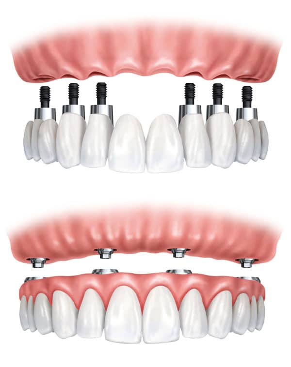 full mouth dental implants cost