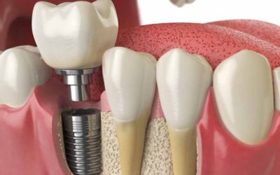 low cost dental implants