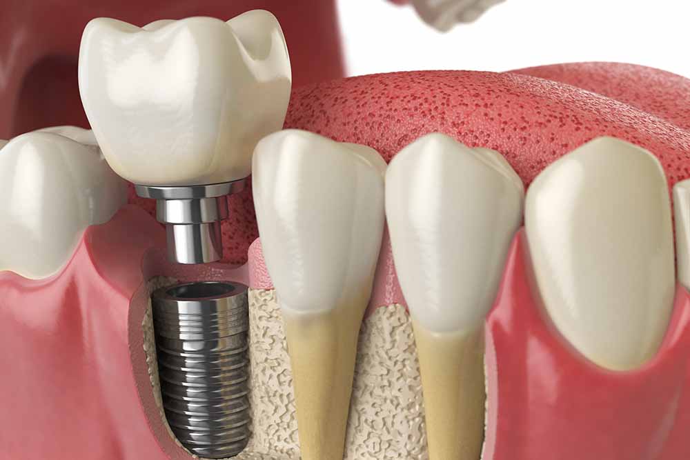 Low Cost Dental Implants