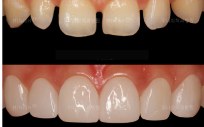 Cavity Filling Excellence: Affordable Solutions for Healthy Teeth