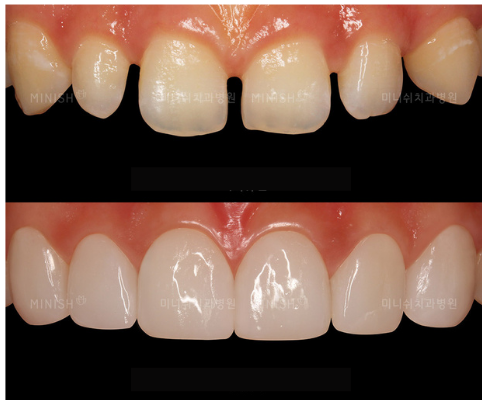 teeth gap filling cost