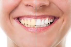 Teeth Bleaching Near Me: Brighten Your Smile Today