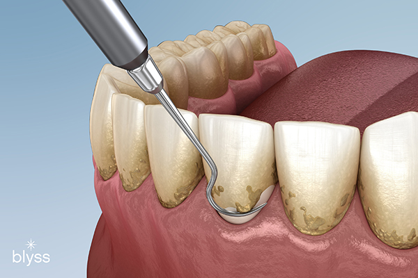 Teeth Whitening Dentist Cost: Affordable Smile Brilliance