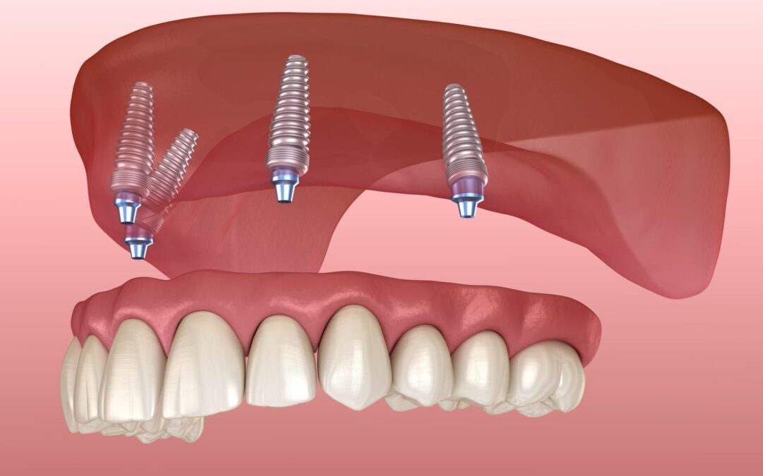 Denture Implants: Secure Smiles, Lasting Confidence