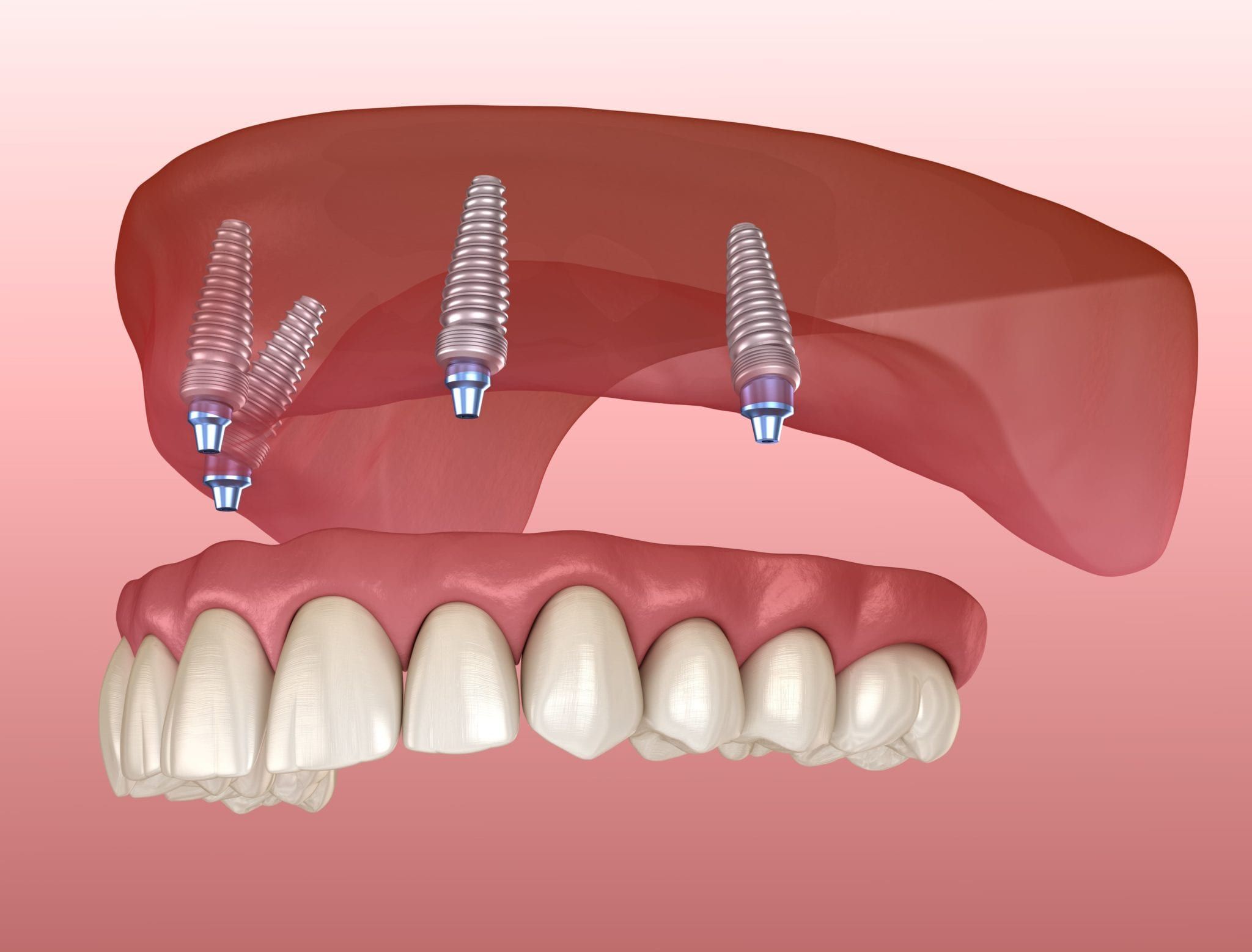 denture implants