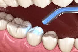 dental filling restoration