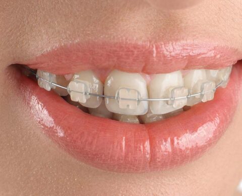 Clear Braces: Straighten Your Smile with Confidence