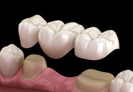 dental bridges