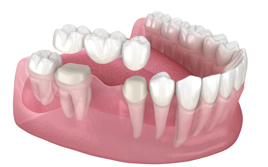 Dental Bridge Cost: Affordable Solutions for Your Smile