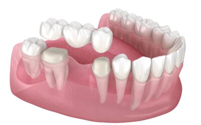 Dental Bridge Cost: Affordable Solutions for Your Smile