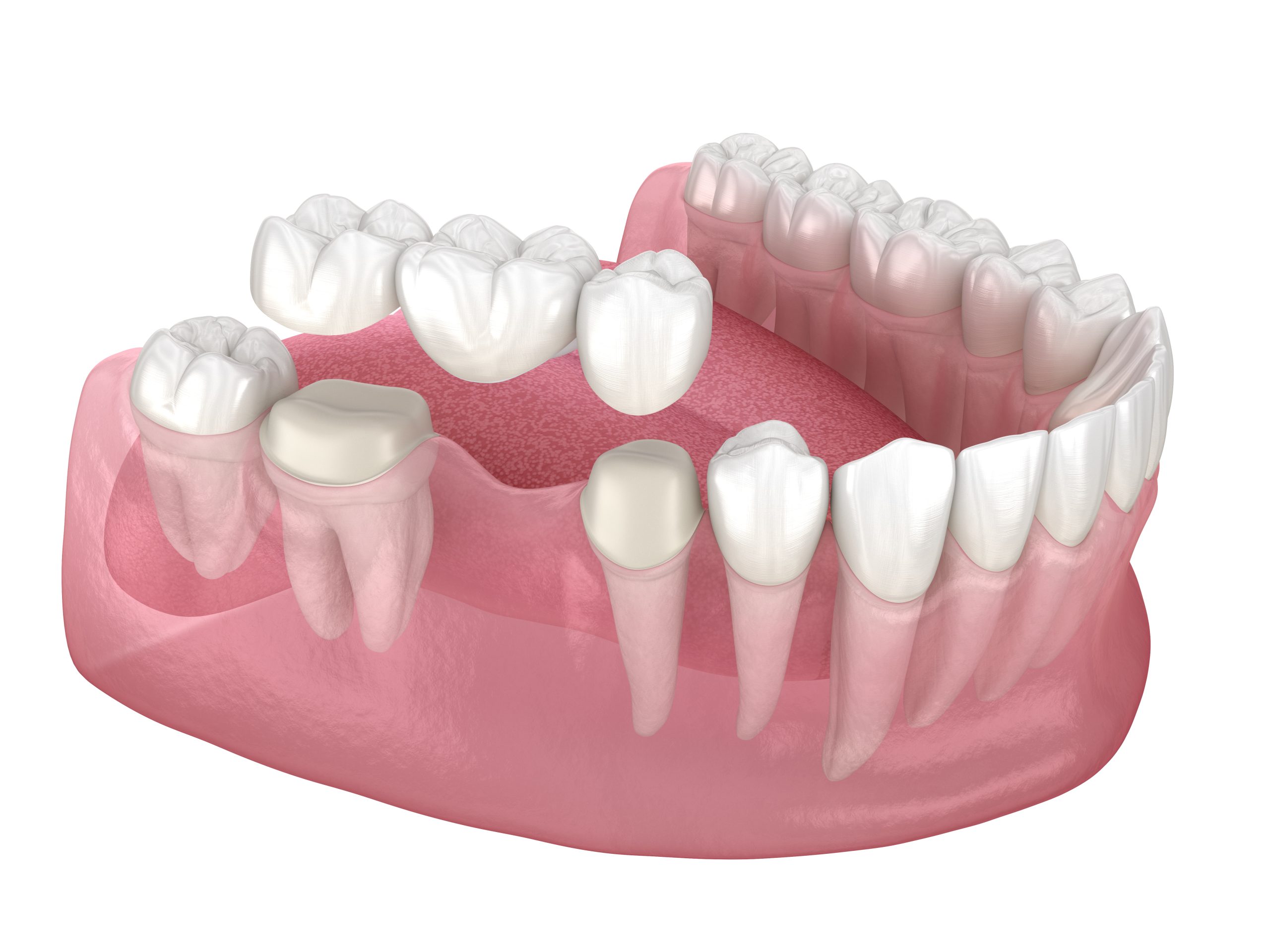 dental bridge cost dental bridge cost