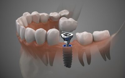 Impactful Implant Crowns: Restore Your Smile with Precision