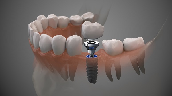 implant crowns implant crowns