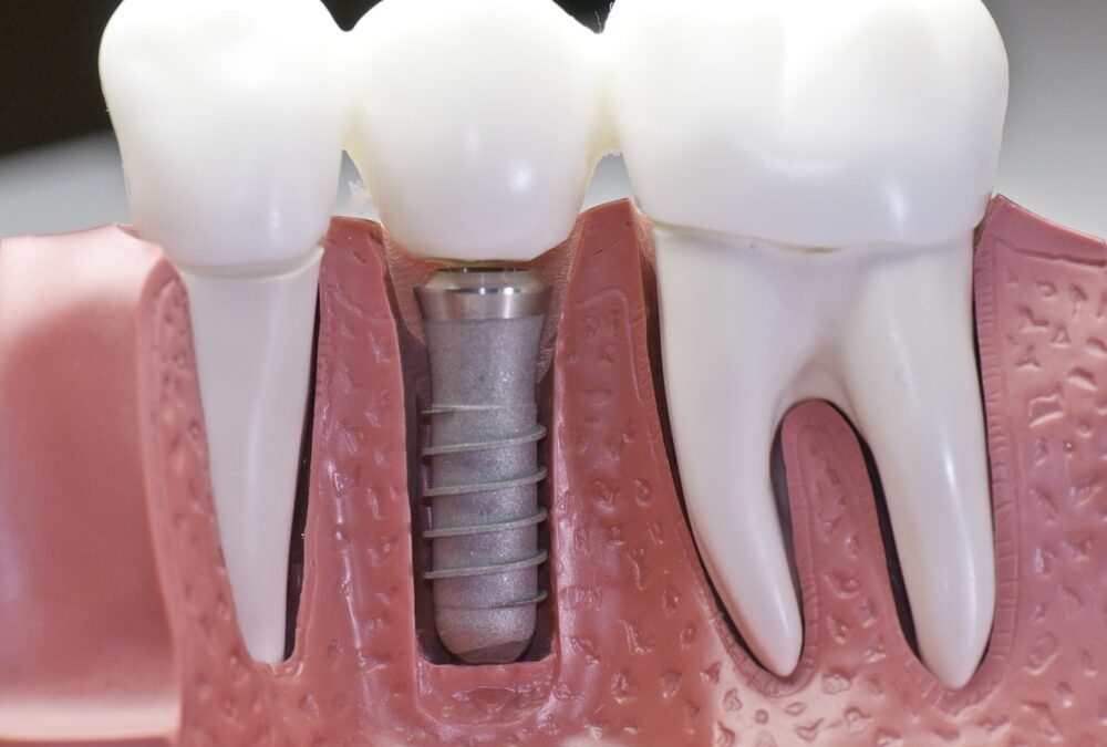 Cost of Dental Bridge Implants – Get a Free Consultation & Quote Today
