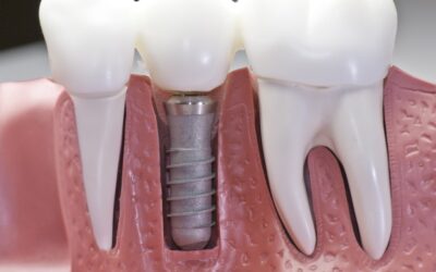 Cost of Dental Bridge Implants – Get a Free Consultation & Quote Today