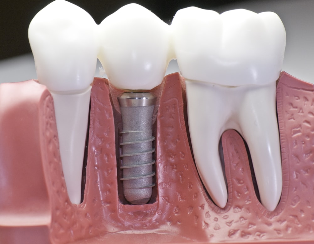 cost of dental bridge implants cost of dental bridge implants