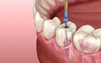 Dental Filling Cost – What to Expect & How to Save Money